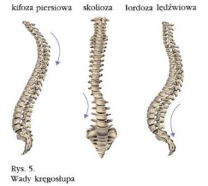 skolioza wygięcia kręgosłupa